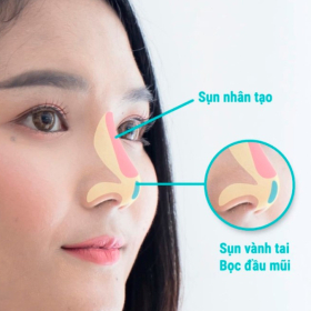 Nâng mũi sụn nhân tạo là gì? 