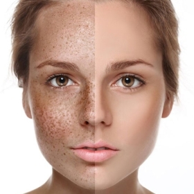 Trị nám bằng retinol là gì ?